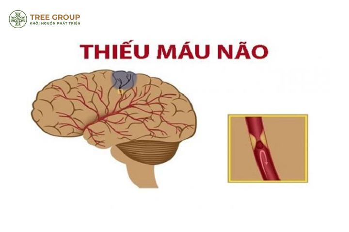 Thiếu máu não: Nguyên nhân và cách khắc phục?